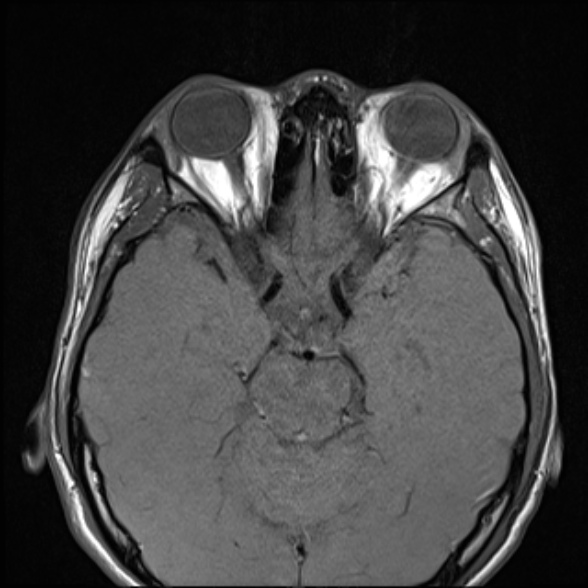 Nasopharyngeal carcinoma with skull base invasion (Radiopaedia 53415-59485 Axial T1 15).jpg