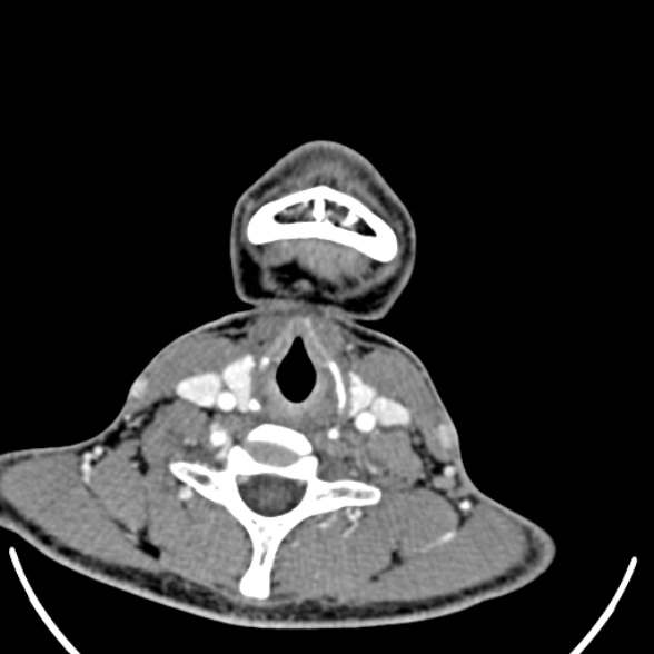 Nasopharyngeal carcinoma with skull base invasion (Radiopaedia 53415-59705 A 156).jpg