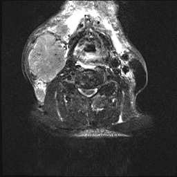 File:Nasopharyngeal carcinoma with skull base invasion (Radiopaedia 59258-66600 Axial T2 fat sat 5).jpg