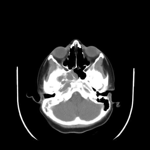 File:Nasopharyngeal rhabdomyosarcoma (Radiopaedia 23417-23491 Axial non-contrast 4).jpg