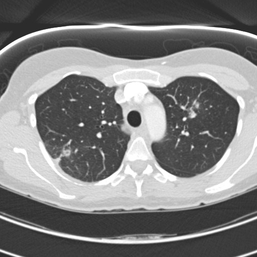 Necrobiotic pulmonary nodules - Crohn disease (Radiopaedia 20723-20631 Axial lung window 40).jpg