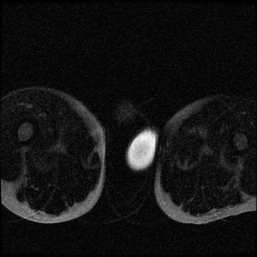 File:Necrotizing epididymo-orchitis with intra-testicular abscess (Radiopaedia 29397-29860 Axial T2 fat sat 18).jpg