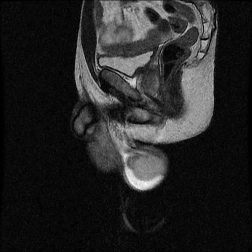 File:Necrotizing epididymo-orchitis with intra-testicular abscess (Radiopaedia 29397-29860 Sagittal T2 9).jpg