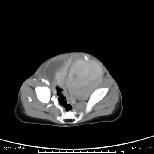 File:Neuroblastoma (Radiopaedia 41472-44355 A 37).jpg
