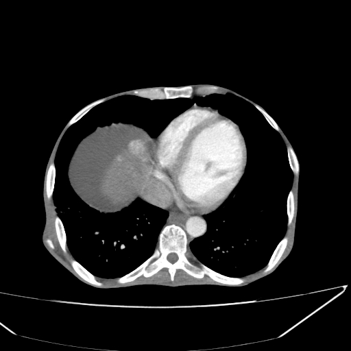 File:Neuroendocrine tumor of pancreas (Radiopaedia 50875).jpg