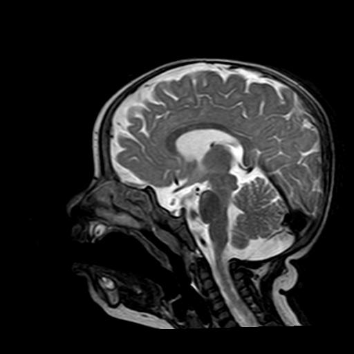 File:Neurofibromatosis type 1 (Radiopaedia 30089-30671 Sagittal T2 8).jpg