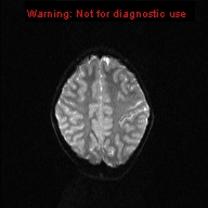 File:Neurofibromatosis type 1 with optic nerve glioma (Radiopaedia 16288-15965 Axial DWI 6).jpg