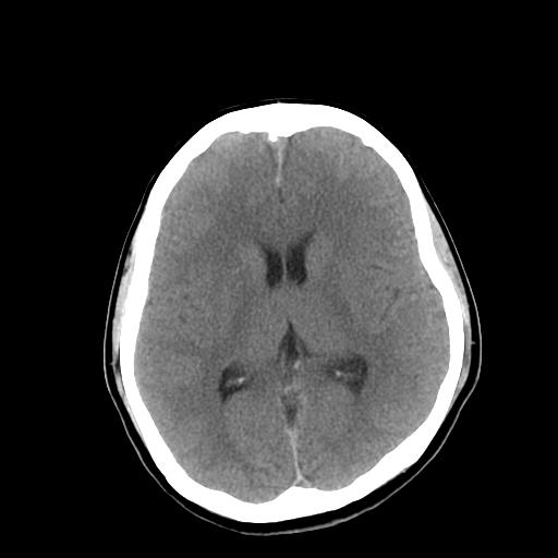 File:Neurofibromatosis type 2 (Radiopaedia 25389-25637 Axial non-contrast 14).jpg