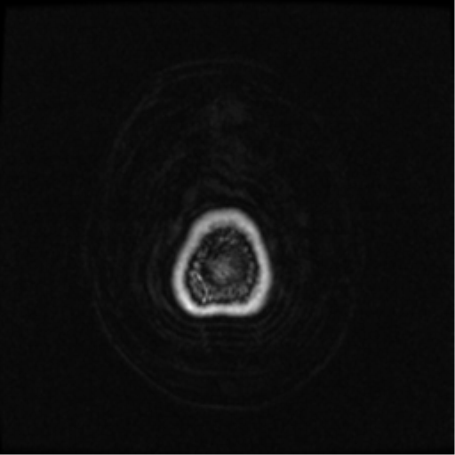 Neurofibromatosis type 2 (Radiopaedia 45229-49244 Axial T1 C+ 115).png