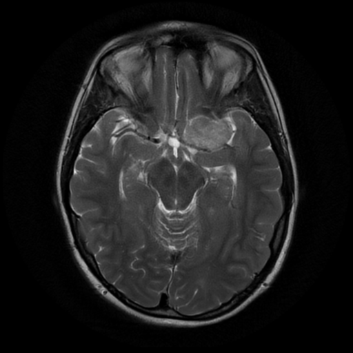 File:Neurofibromatosis type 2 (Radiopaedia 45229-49244 Axial T2 8).png