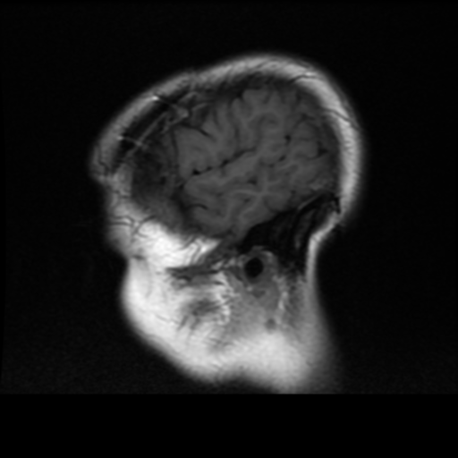 File:Neurofibromatosis type 2 (Radiopaedia 45229-49244 Sagittal T1 19).png
