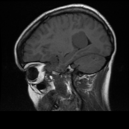 File:Neurofibromatosis type 2 (Radiopaedia 45229-49244 Sagittal T1 6).png
