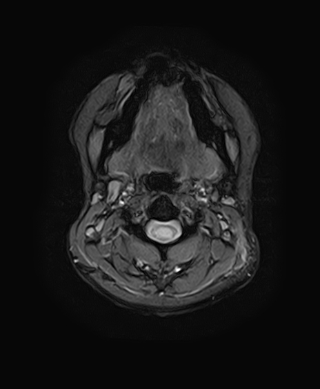 File:Neurofibromatosis type 2 (Radiopaedia 66211-75401 Axial Gradient Echo 2).jpg
