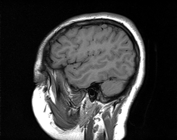 File:Neurofibromatosis type 2 (Radiopaedia 66211-75401 Sagittal T1 5).jpg
