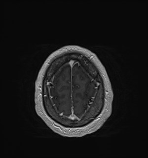 Neurofibromatosis type 2 (Radiopaedia 79097-92049 Axial T1 C+ 173).jpg