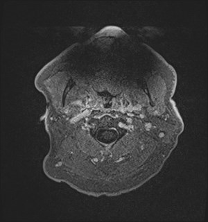 Neurofibromatosis type 2 (Radiopaedia 79097-92049 Axial T1 C+ 2).jpg