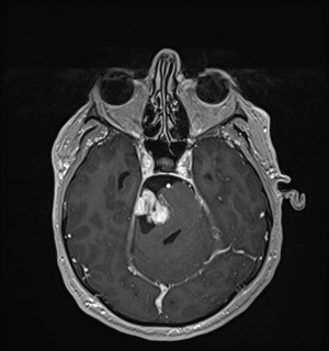 Neurofibromatosis type 2 (Radiopaedia 79097-92049 Axial T1 C+ 72).jpg