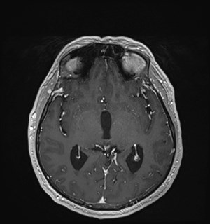 Neurofibromatosis type 2 (Radiopaedia 79097-92049 Axial T1 C+ 98).jpg