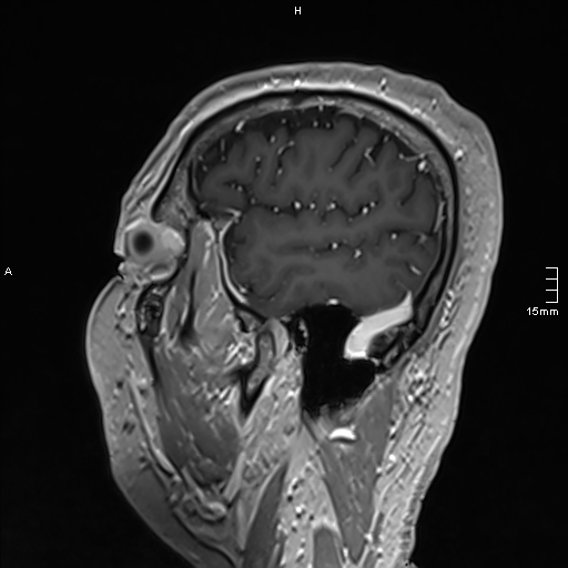 Neurosarcoidosis - involvement of the mesial temporal lobes (Radiopaedia 67429-76820 Sagittal T1 C+ 34).jpg