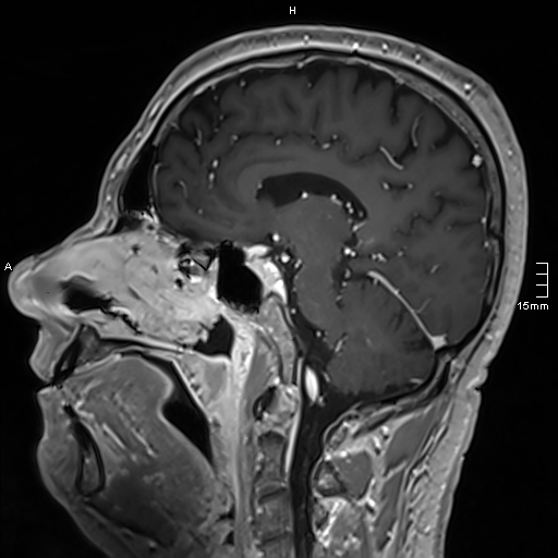 Neurosarcoidosis - involvement of the mesial temporal lobes (Radiopaedia 67429-76820 Sagittal T1 C+ 77).jpg