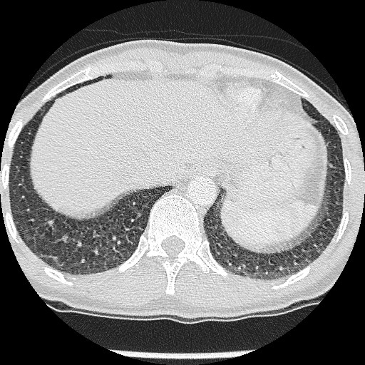 File:Non-small cell lung cancer with miliary metastases (Radiopaedia 23995-24193 Axial lung window 21).jpg