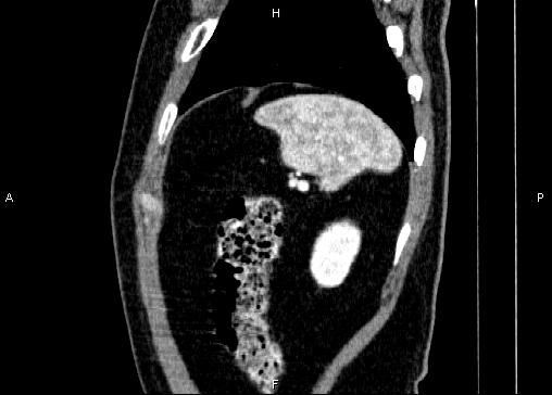 Non-syndromic pancreatic endocrine tumor (Radiopaedia 86958-103178 E 89).jpg