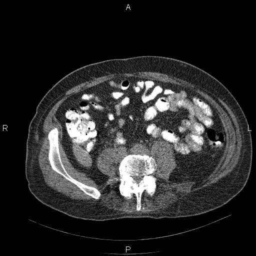 File:Non Hodgkin lymphoma in a patient with ankylosing spondylitis (Radiopaedia 84323-99624 Axial non-contrast 49).jpg