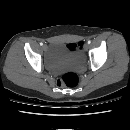 File:Normal CT angiogram of pelvis (Radiopaedia 45390-49430 A 41).jpg