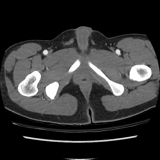 File:Normal CT angiogram of pelvis (Radiopaedia 45390-49430 A 56).jpg