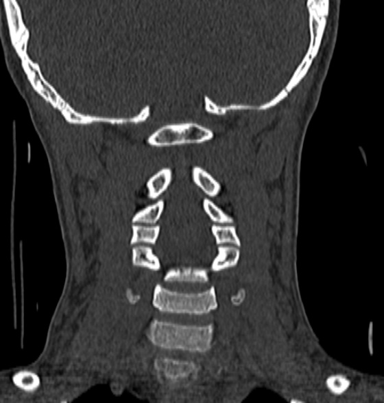 File:Normal CT cervical spine - 12-year-old (Radiopaedia 55352-61775 Coronal bone window 126).jpg