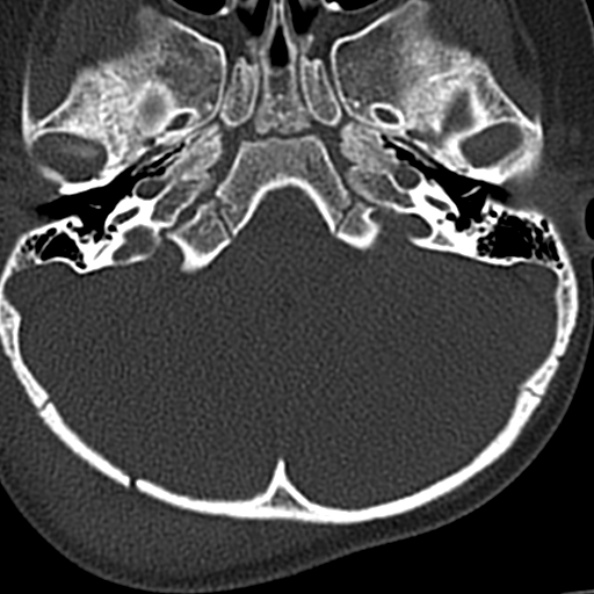 Normal Ct Cervical Spine Pediatric Radiopaedia Axial Bone Window Nc Commons