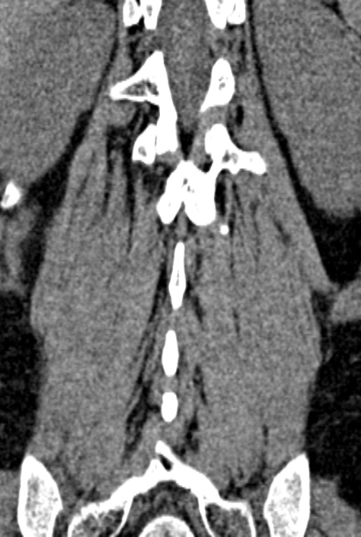 Normal CT lumbar spine (Radiopaedia 53981-60118 F 76).jpg