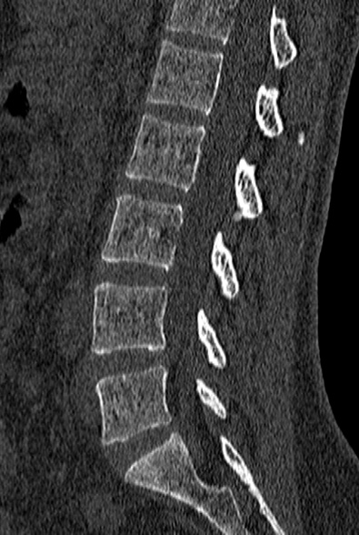 File:Normal CT lumbar spine (Radiopaedia 53981-60118 Sagittal bone window 53).jpg
