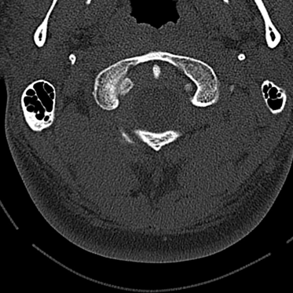 Normal CT of the cervical spine (Radiopaedia 53322-59305 Axial bone window 50).jpg