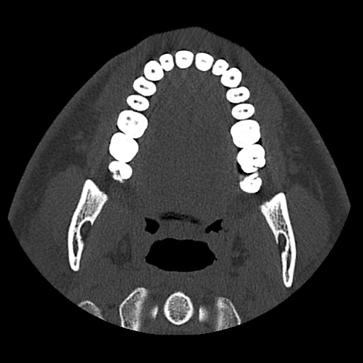 Normal CT paranasal sinuses (Radiopaedia 42286-45390 Axial bone window 112).jpg