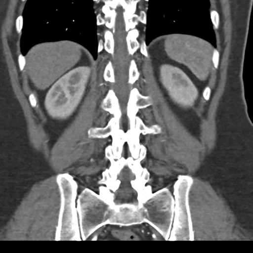 File:Normal CT renal artery angiogram (Radiopaedia 38727-40889 B 59).png