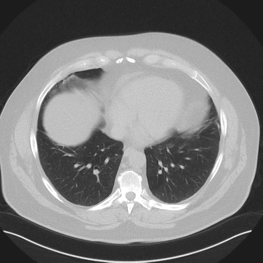 Normal HRCT (Radiopaedia 40797-43458 Axial lung window 40).png