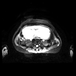 Normal MRI abdomen in pregnancy (Radiopaedia 88001-104541 Axial DWI 19).jpg