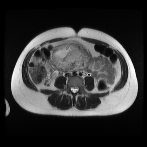 Normal MRI abdomen in pregnancy (Radiopaedia 88003-104546 Axial T2 23).jpg