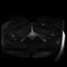 Normal MRI abdomen in pregnancy (Radiopaedia 88005-104548 Axial DWI 75).jpg