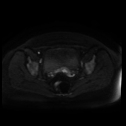 Normal MRI abdomen in pregnancy (Radiopaedia 88005-104548 Axial DWI 88).jpg