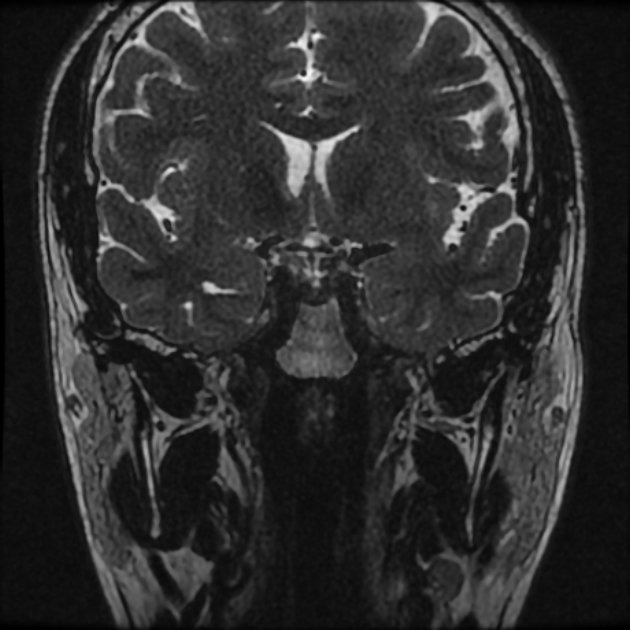 Normal MRI petrous (Radiopaedia 91317-108949 Coronal T2 4).jpg