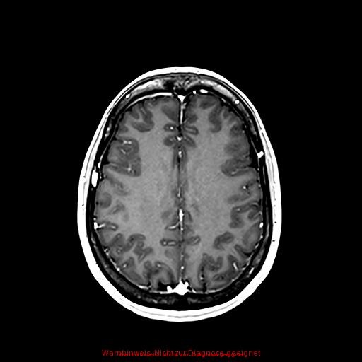 Normal adult brain MRI (non-enhanced and contrast-enhanced) (Radiopaedia 75262-86379 Axial T1 C+ 130).jpg