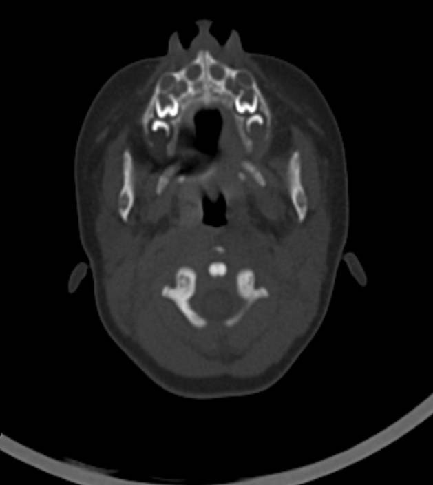 Normal brain CT - 2-month-old (Radiopaedia 53369-59350 Axial bone window 58).jpg