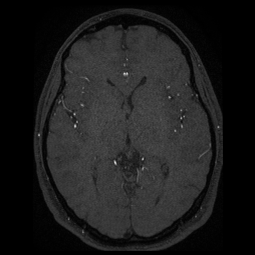Normal brain MRA (Radiopaedia 41046-43793 Axial MRA 27).png
