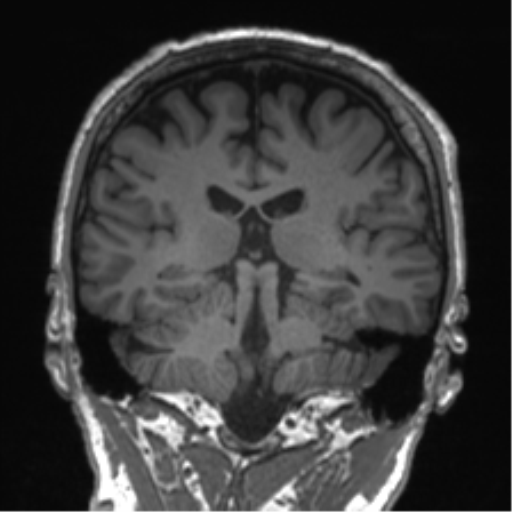 Normal brain MRI (non-focal epilepsy protocol) (Radiopaedia 53917-60040 Coronal T1 29).png