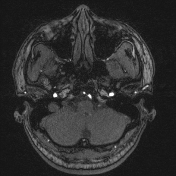 Normal brain MRI including MRA (Radiopaedia 48748-53763 Axial MRA 28).jpg