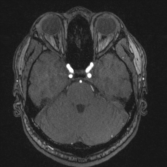 Normal brain MRI including MRA (Radiopaedia 48748-53763 Axial MRA 61).jpg