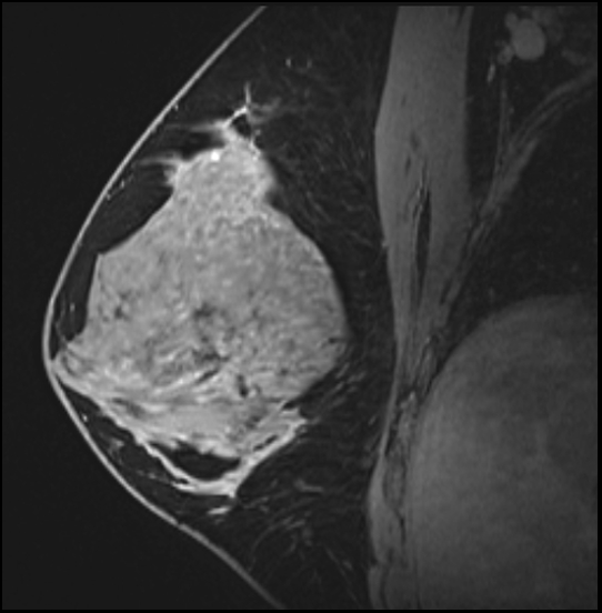 Normal breast MRI - dense breasts (Radiopaedia 80454-93850 I 86).jpg