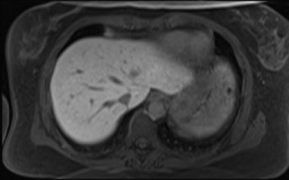 File:Normal hepatobiliary phase liver MRI (Radiopaedia 58968-66230 A 20).jpg